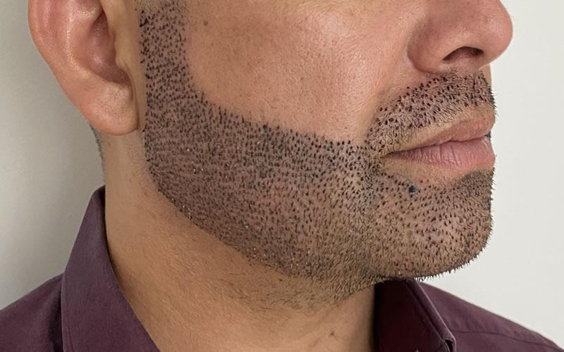 Imagem ilustrativa do transplante de barba